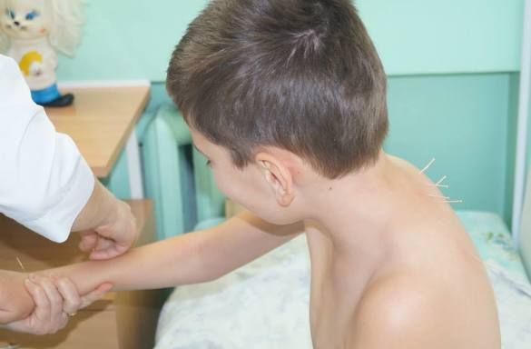 Иглорефлексотерапия в БОЦМР "Тонус"